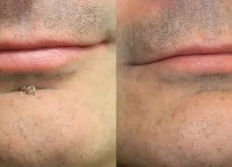 VUSSUV® Microneedle Clear Patches ✨Targets Skin Tags, Acne, Wrinkles & Blemishes