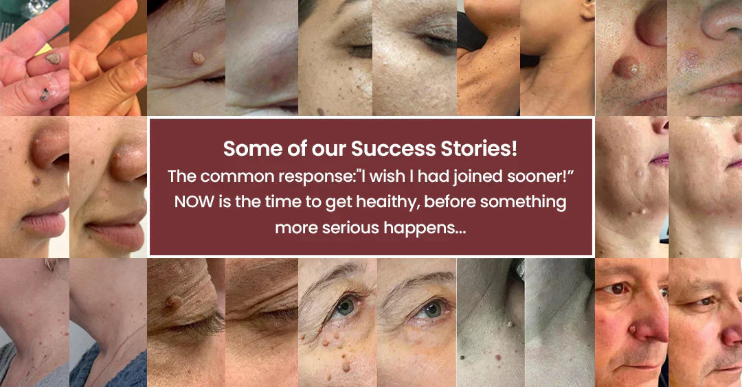 VUSSUV® Microneedle Clear Patches ✨Targets Skin Tags, Acne, Wrinkles & Blemishes