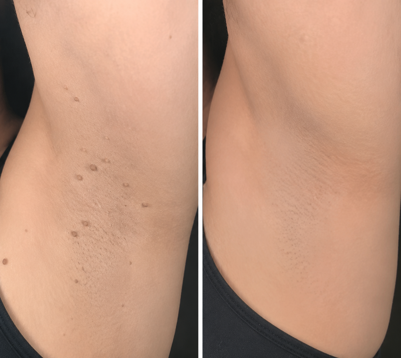 VUSSUV® Microneedle Clear Patches ✨Targets Skin Tags, Acne, Wrinkles & Blemishes