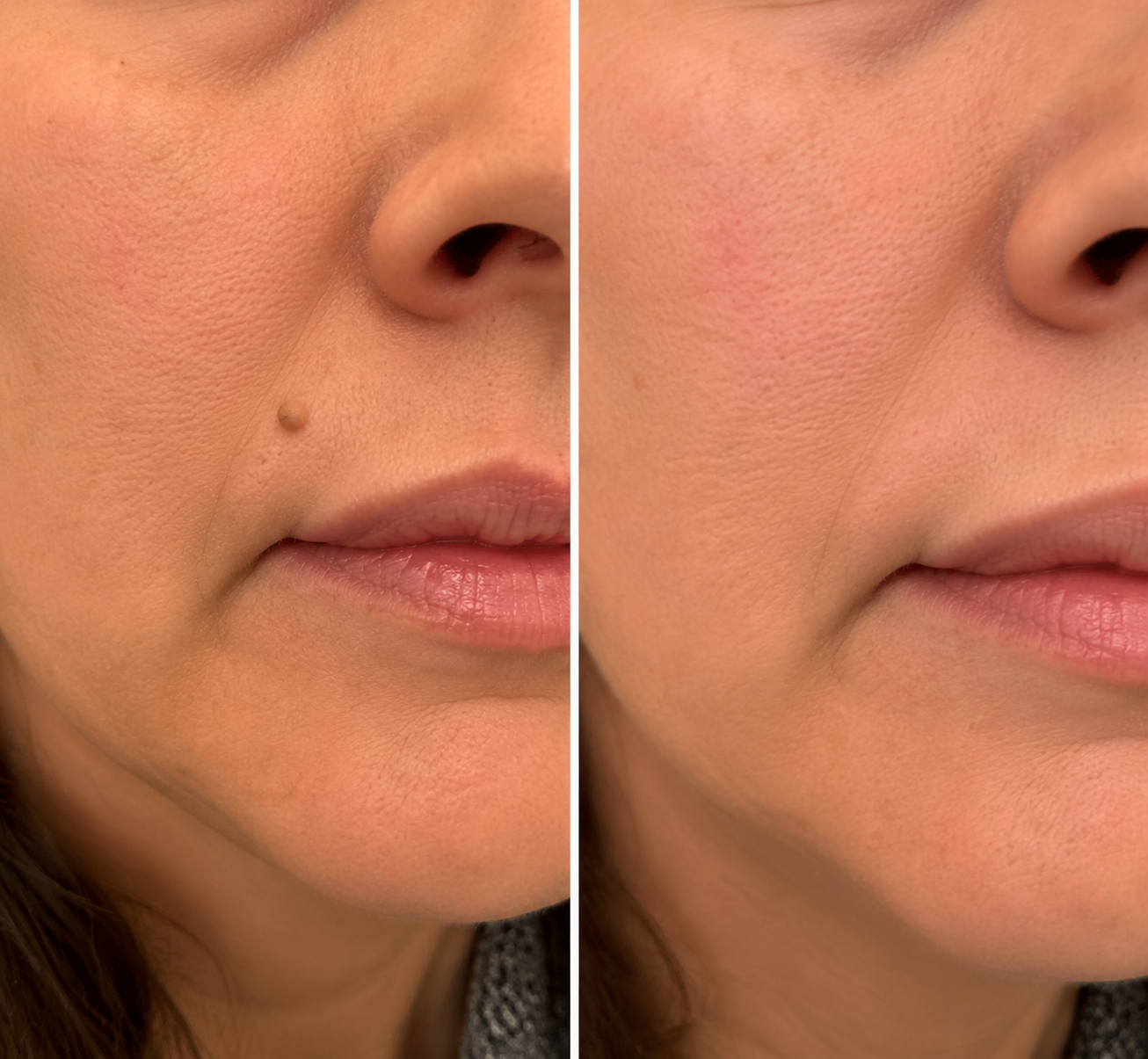 VUSSUV® Microneedle Clear Patches ✨Targets Skin Tags, Acne, Wrinkles & Blemishes
